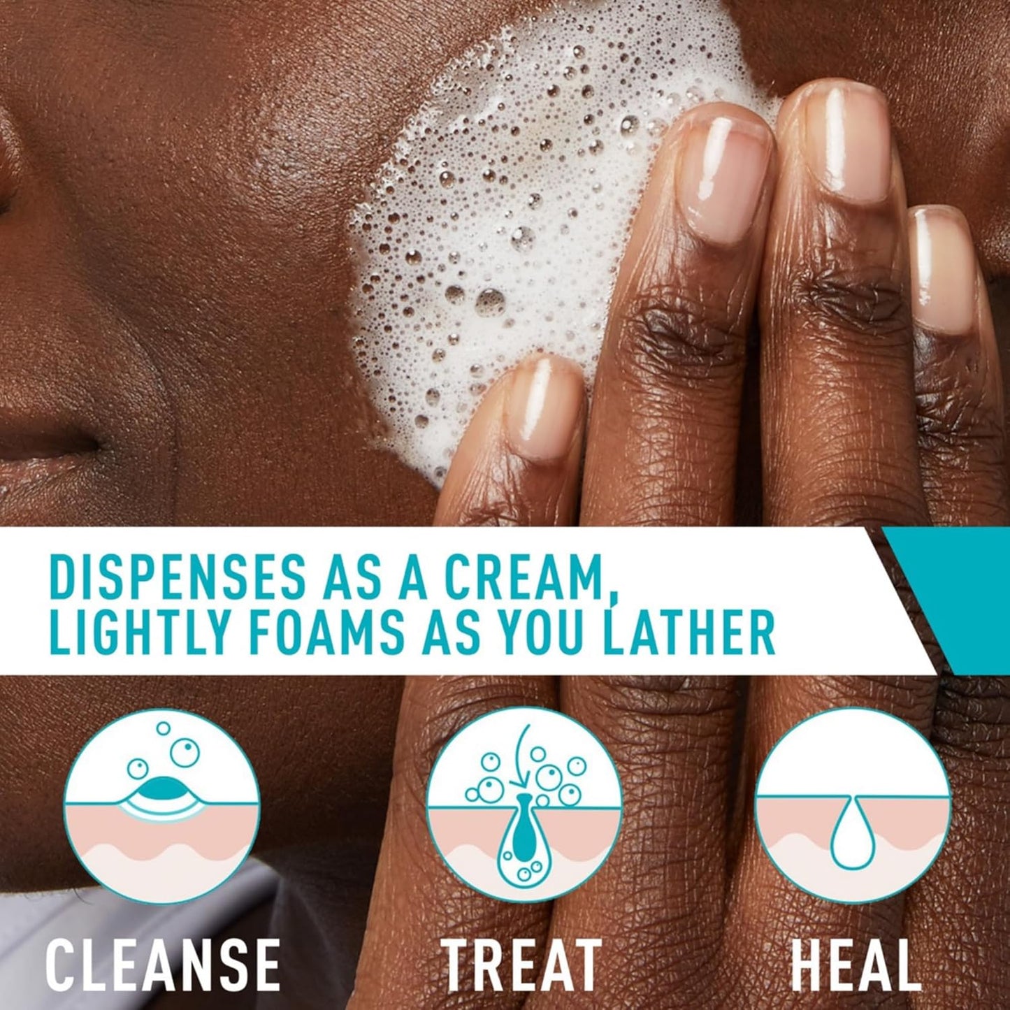 Acne Foaming Cream Cleanser, 4% Benzoyl Peroxide Face Wash with Hyaluronic Acid, Niacinamide & Ceramides, Gentle Daily Acne Treatment for Face
